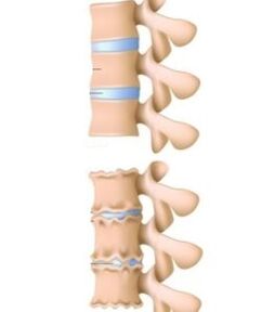 Les causes de l'ostéochondrose
