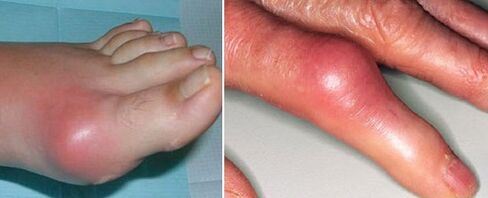 Apparition d'articulations souffrant d'arthrite