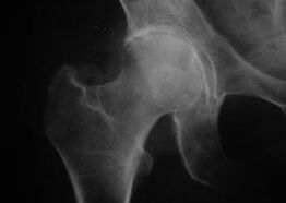 Radiographie de l'articulation de la hanche avec arthrose