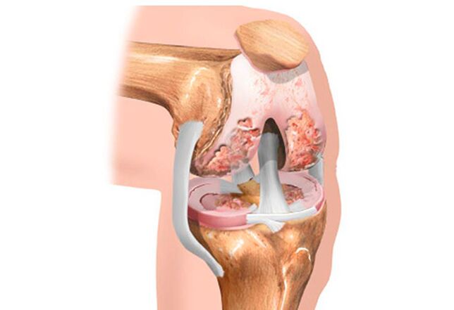 Arthrose de l'articulation du genou