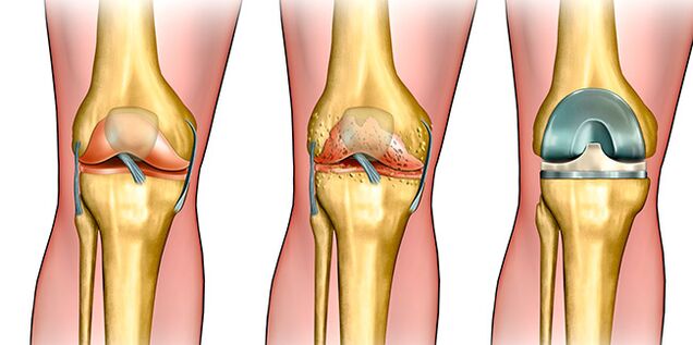 Au troisième stade de l'arthrose, une arthroplastie du genou est nécessaire