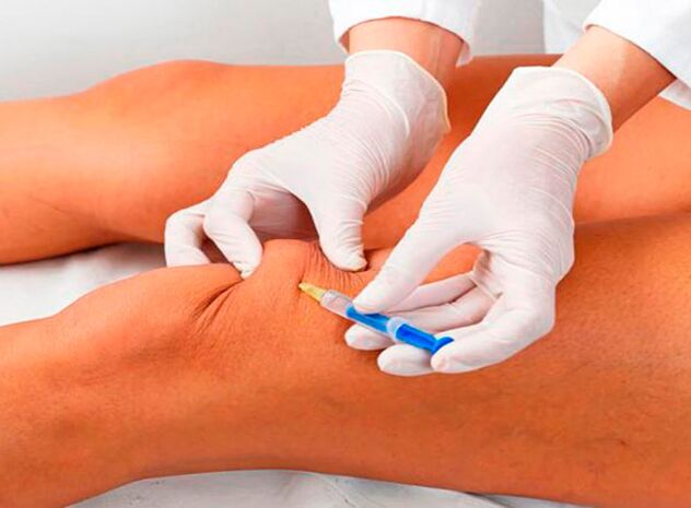 Injections intra-articulaires de médicaments pour l'arthrose de l'articulation du genou